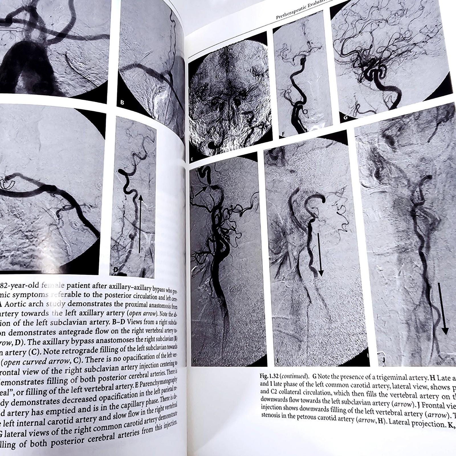 Springer Surgical Neuroangiography Berenstein Vol 2.1 2.2 Hardcover 2nd Ed 2004